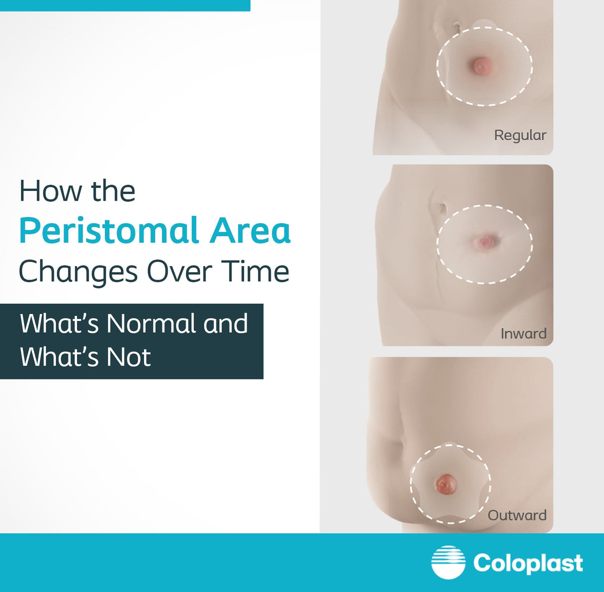 Peristomal skin care and changes after ostomy surgery