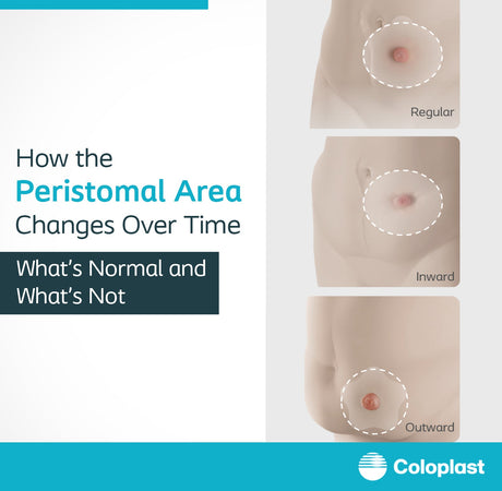 Peristomal skin care and changes after ostomy surgery