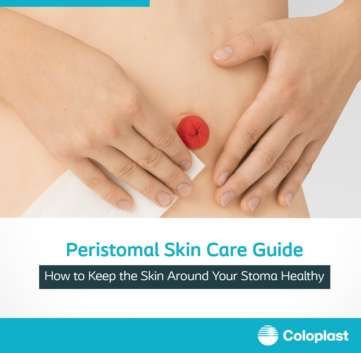 Peristomal skin care tips for healthy skin around the stoma