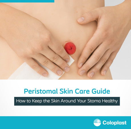 Peristomal skin care tips for healthy skin around the stoma