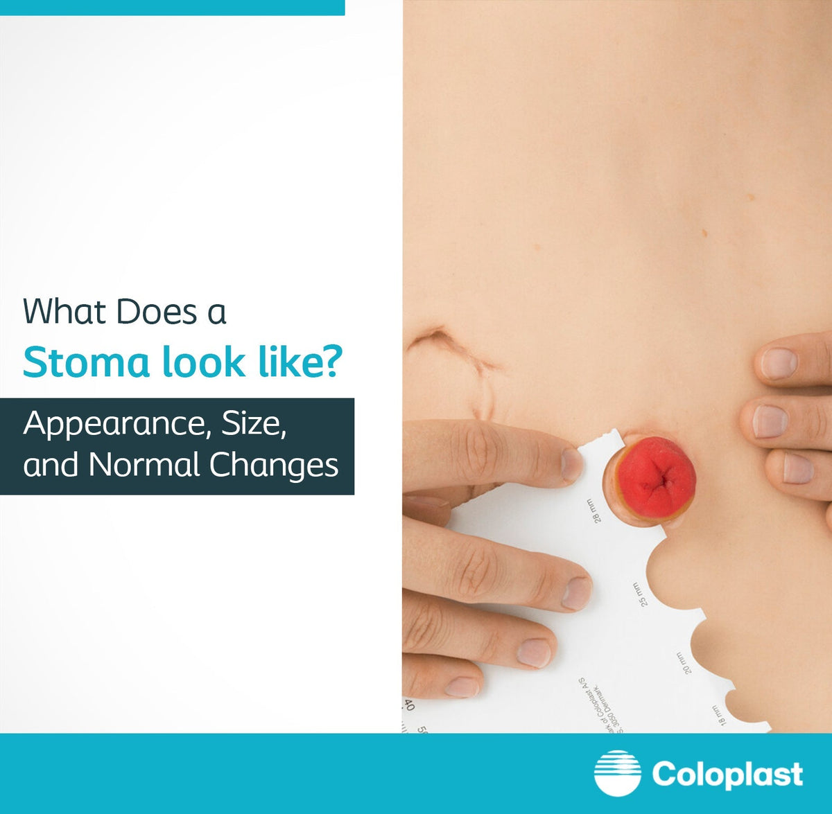Stoma appearance and care after ostomy surgery